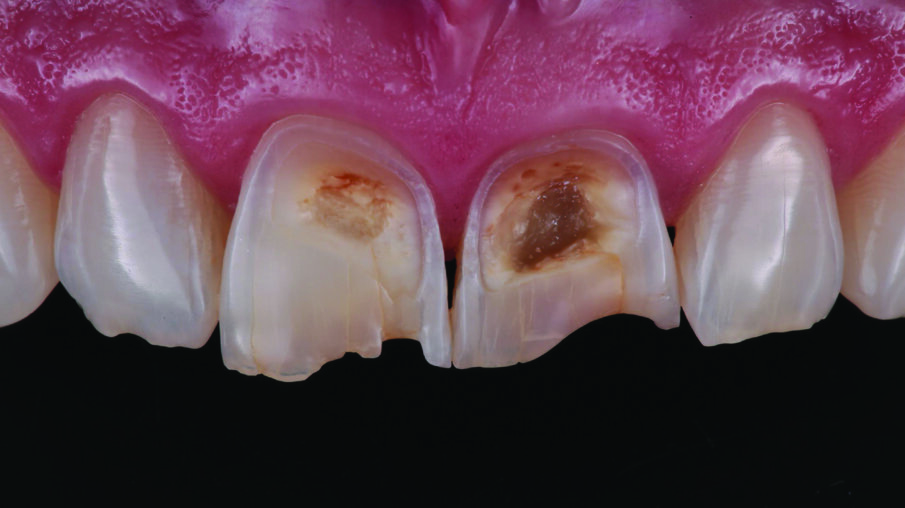 Detailed view of the maxillary incisors. The teeth didn’t show any highly translucent areas, so the use of a single shade/opacity of 3M™ Filtek™ Universal Restorative was selected.