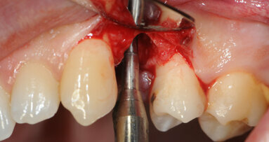 Immediate implants in the esthetic area: Our perspective and clinical guidelines