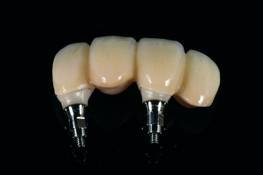 Fig. 40: Final restoration (performed by dental technician Chunyu Duan).