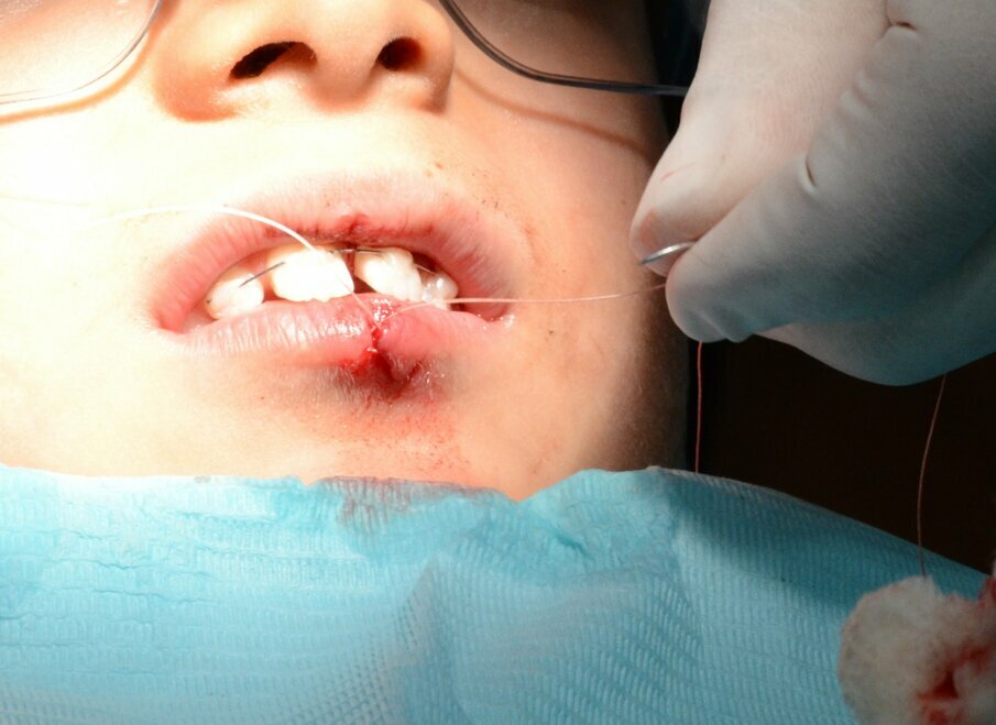 Figure 8. Suturing of the lower lip laceration in three layers using fine resorbable sutures (Vicryl® Sizes 40 and 60).