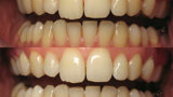 Figura 4. Antes y después del blanqueamiento dental en el consultorio de un paciente con tratamiento ortodóntico lingual.