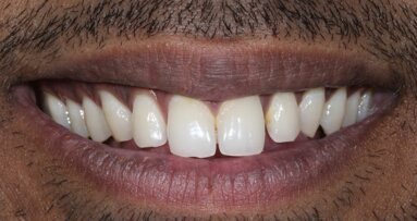 Smile makeover with composite veneers using injection moulding - Dr. Stephen D'souza