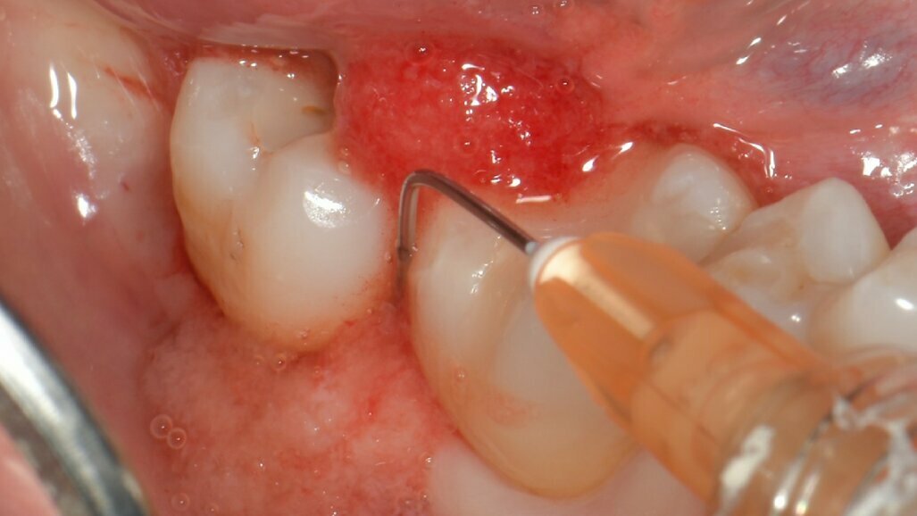 Utilizzo di un nuovo hydrogel collagenico nel trattamento di tasche parodontali: una case series