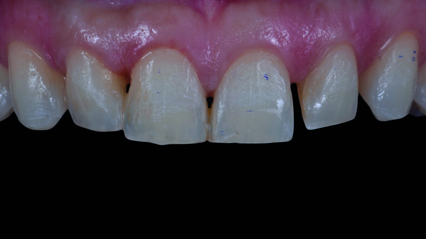Fig. 7 : Tissu parodontal des dents antérieures six mois après l‘élongation coronaire. 
