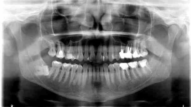Powikłania jatrogenne w chirurgii stomatologicznej – przegląd piśmiennictwa i opis przypadków