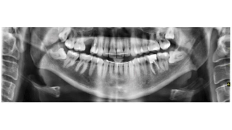 Retratamiento no quirúrgico de una periodontitis apical sintomática