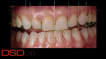 Fig. 3. Diseño de sonrisa digital que indica el alargamiento de las coronas de los dientes #13, 12, 11 y 21 y el tratamiento restaurador de los diez dientes anteriores.