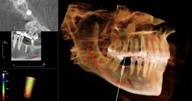 InVivo Dental – doskonała diagnostyka w implantologii