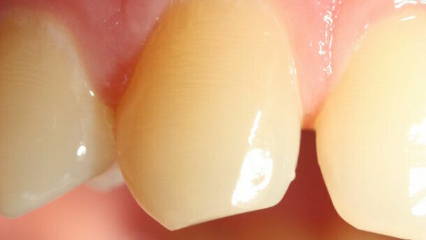 Exposição precoce ao BPA pode afetar negativamente a formação do esmalte dentário