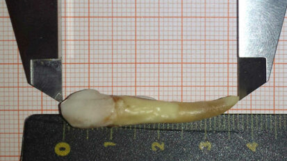 Nový světový rekord: Německý zubní lékař extrahoval nejdelší lidský zub na světě