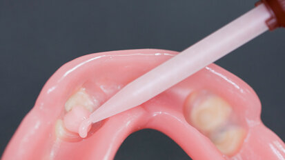 New Quick Up method eliminates risk of accidental locking of dentures, cuts procedure time in half