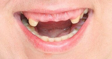 Загубата на зъби може да забави умствените и физическите функции