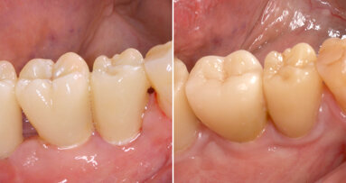 First long-term study on two-piece zirconia implants published