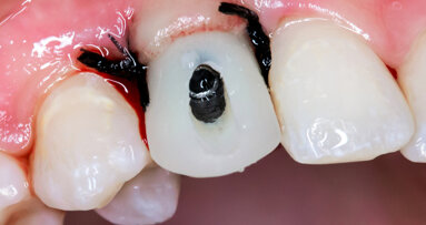 Study compares immediate with early and conventional loading of dental implants