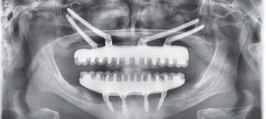 Fig. 9 - Ortopantomografia realizzata dopo la collocazione della protesi definitiva.