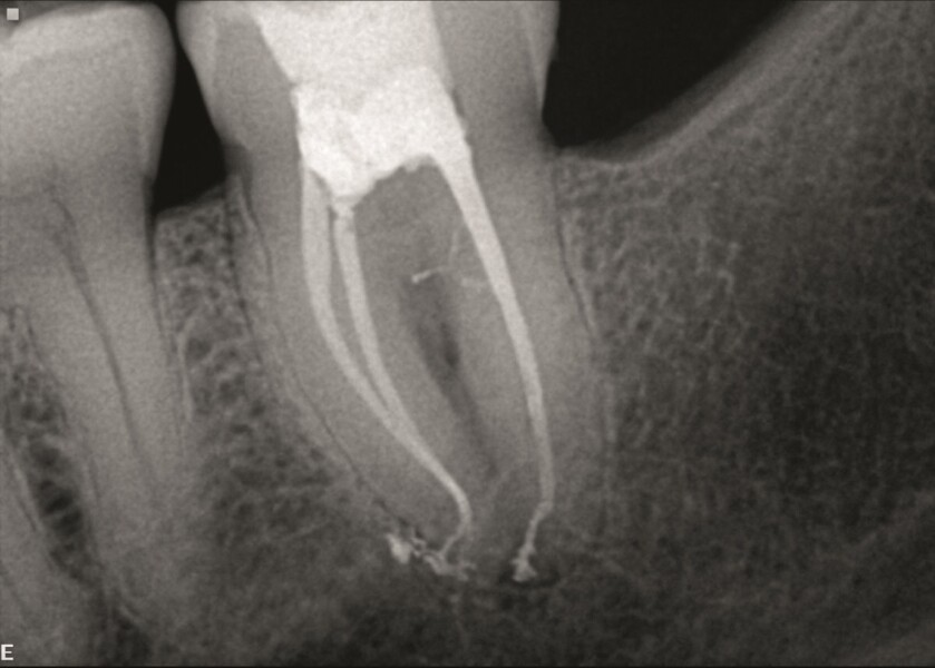 Fig. 11b : Radiographie prise immédiatement après le traitement, montrant les canaux latéraux obturés dans la partie coronaire du canal distal.
