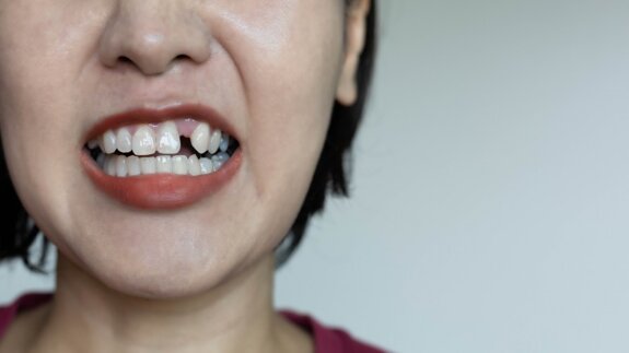Badania wykazały, że słaba kontrola glikemii prowadzi do utraty zębów w średnim wieku