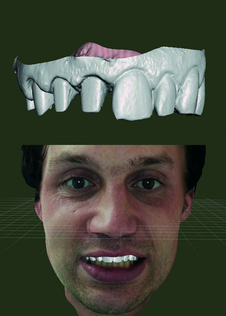 Fig. 19: Virtual simulation on Meshmixer: mirror 3D duplication of initial situation of teeth #21, 22, 23 and 24 to replace teeth #11, 12, 13 and 14.