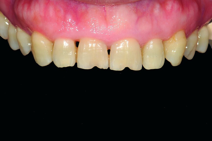 Fig. 7: Upper-anterior dentition view pre-operation.