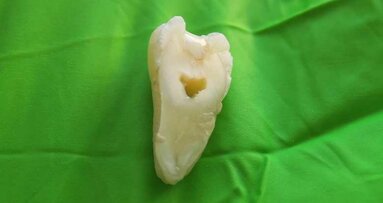 瑞典研究发现： 新型牙齿重建材料能够改善现有的以丙烯酸脂为基础的填充材料