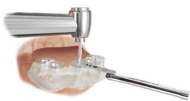 Materialise Dental triples its range of Universal SurgiGuide drill-key diameters