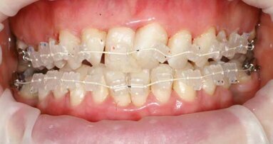 Simple and predictable short-term cosmetic tooth alignment: A case study
