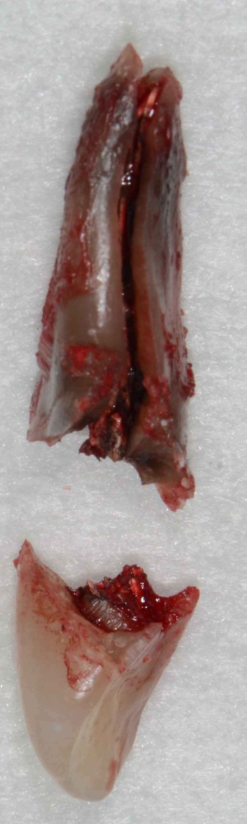 Fig. 3: Clinical view after extraction of fractured tooth #22.