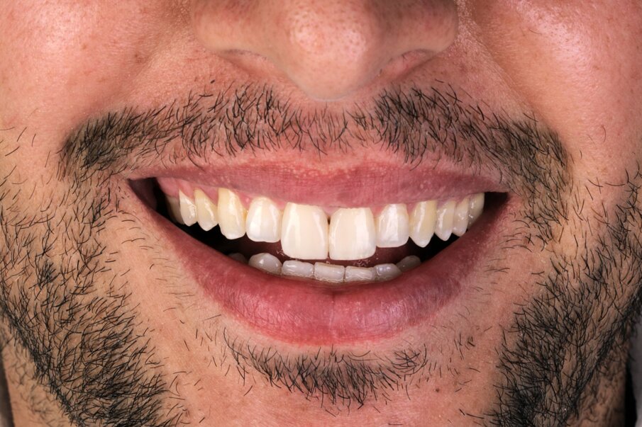 Fig. 1c: Patient’s smile after placing direct composite restorations on the upper central and lateral incisors.