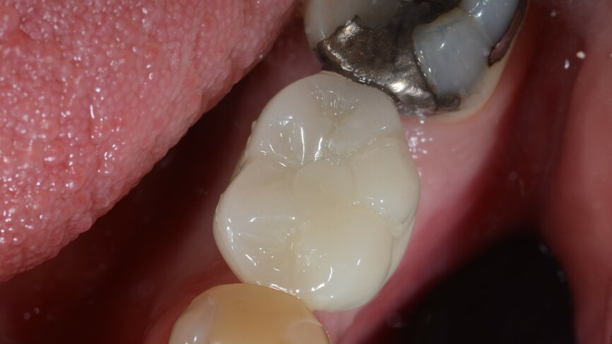 Fig. 13: Temporary crown in position with the screw access channel closed, occlusal view.