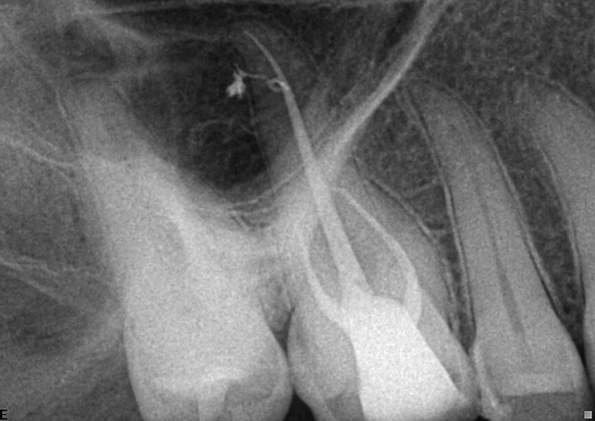 Fig. 6: Vital first upper molar with irreversible pulpitis. Note the extremely long palatal root (approx. 31 mm), nevertheless we managed to seal a beautiful internal loop with a lateral canal, a sign of the proper chemical preparation under partial vacuum and also well dried, allowing the sealer to be compacted inside.
