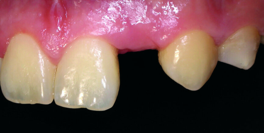 Fig. 2: The patient’s upper teeth before treatment.