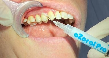 Olio ozonizzato: the new tendency  in Oral Care
