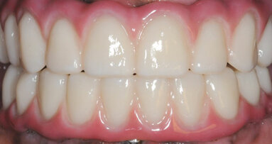 Edentulous arch restored with BruxZir Full-Arch Implant Prosthesis