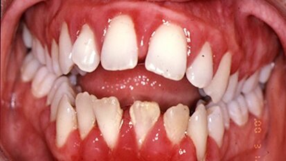 Les bactéries de la bouche accélèrent le développement de la maladie des gencives