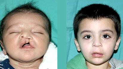 ICLAPA vows to continue free cleft lip and palate treatment
