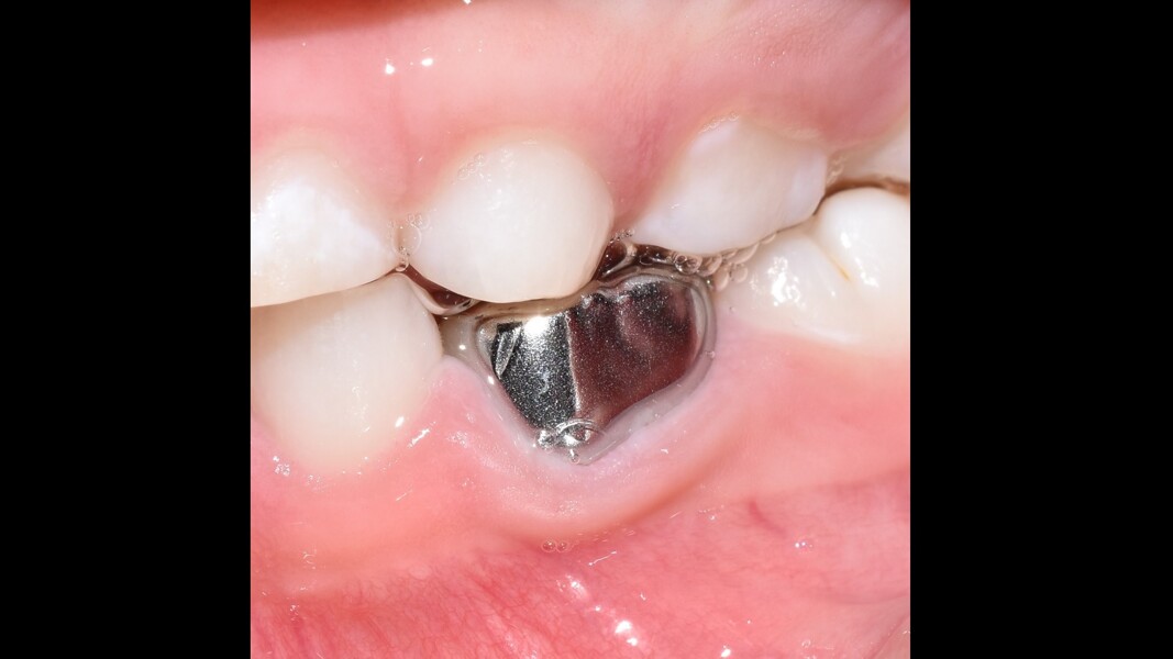 Fig. 18: Clinical aspect at final evaluation showing healthy gingival tissue.