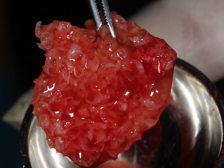 Fig. 11: The ‘gummy bone’ graft material has coalesced into a flexible mass containing the PRP buffy coat, harvested autogenous bone and particulate graft material.  