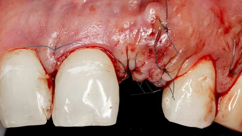 U pacjentów z alergią na penicylinę może wystąpić wyższe ryzyko uszkodzenia implantów zębowych