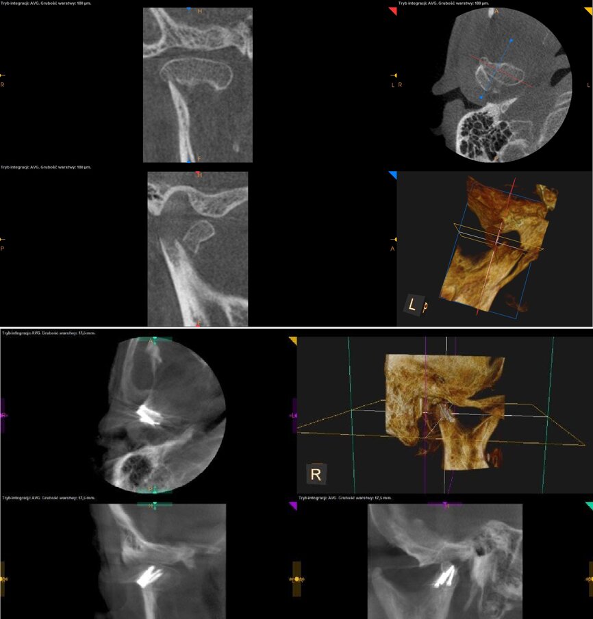Ryc. 7_Tomografia stożkowa o zmiennym polu obrazowania – stan po urazie i po zaopatrzeniu chirurgicznym złamania.