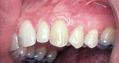 Cosmetic periodontal surgery: Barriers of success