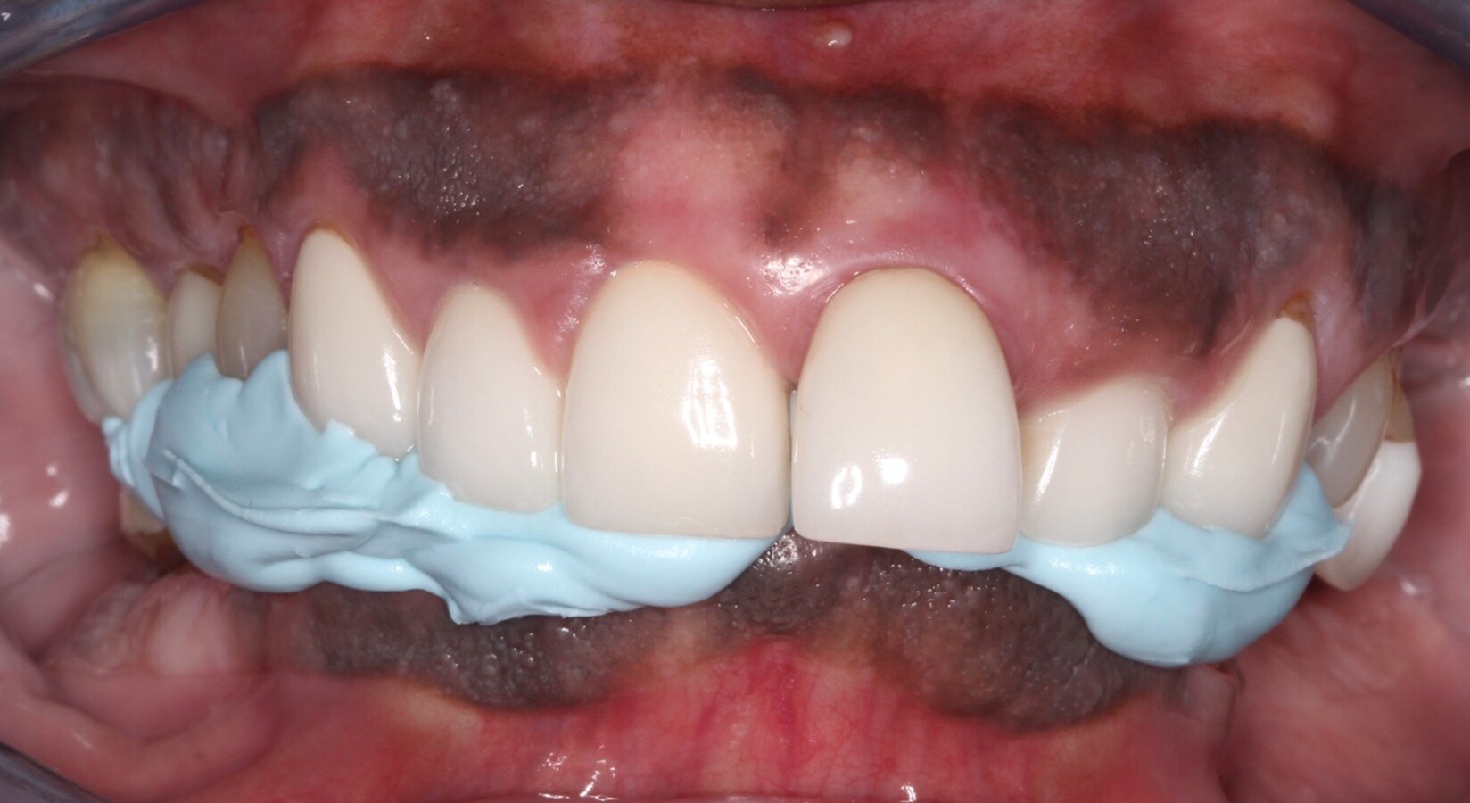 Predictable aesthetic success with a digital workflow