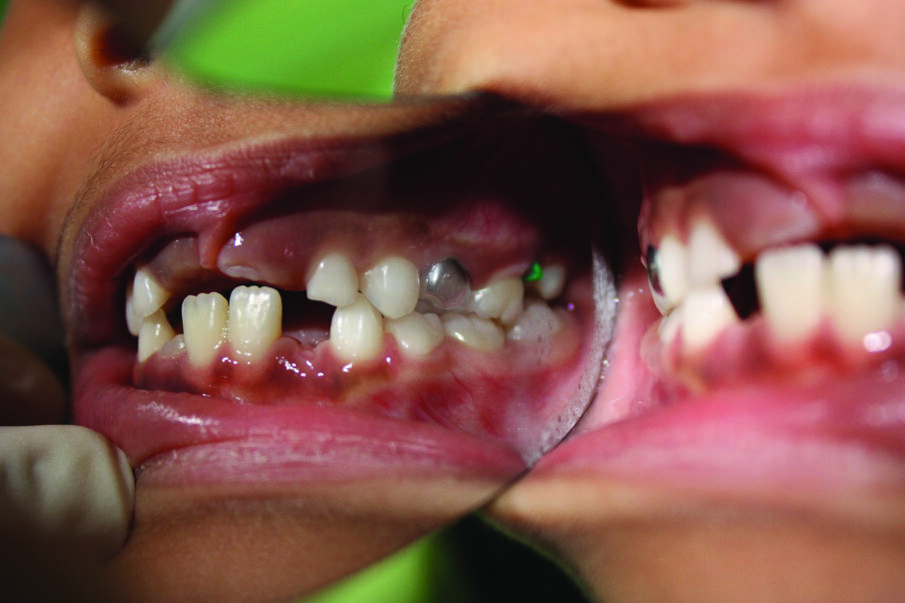 Figure 3: A plastic orthodontic separator is placed to attempt to correct a mild ectopic eruption in the upper right first permanent molar.