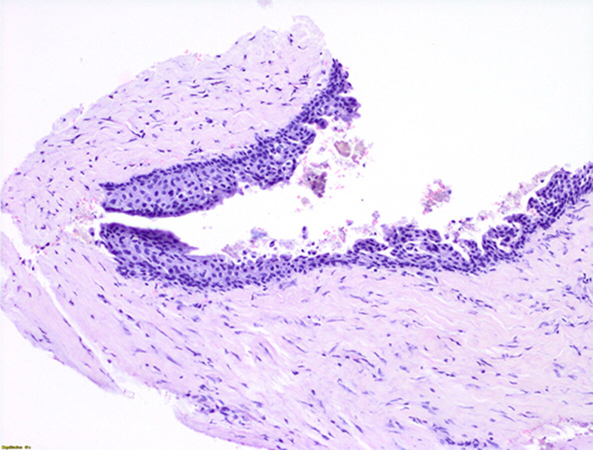 Figura 9. AnÃ¡lisis histopatolÃ³gico. Se observa la pared quÃ­stica compuesta por tejido fibroso y tejido conectivo revestido por un epitelio estratificado no queratinizado, y algunos fragmentos Ã³seos.