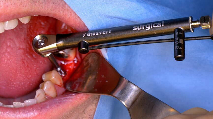 Dental Implant Surgical Instruments