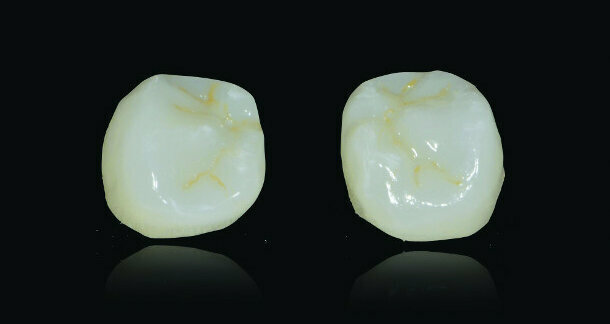 CAD/CAM-fabricated lingual retainers made of nitinol