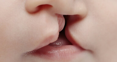 Researchers find genetic mechanism that triggers cleft lip and palate