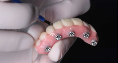 Review recomenda próteses dentárias fixas suportadas por dente e implante