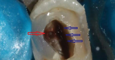Ritrattamento endodontico e restauro adesivo di un secondo premolare strutturalmente compromesso