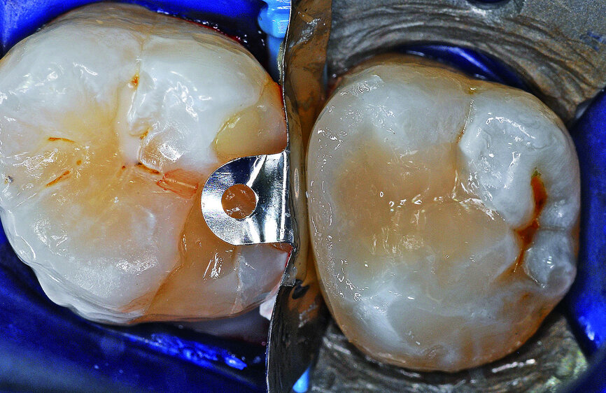 Fig. 18: Pre-endodontic restoration using a combination of SDR bulk fill flowable resin and ceram.x SphereTEC one composite resin.