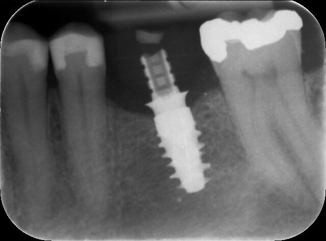 Fig. 12: Radiograph confirming the correct seating of the temporary crown—no gap visible.